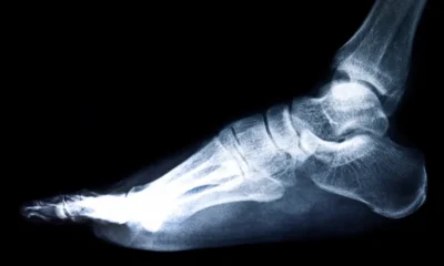 una lastra con un piede affetto da spina calcaneare