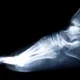 una lastra con un piede affetto da spina calcaneare