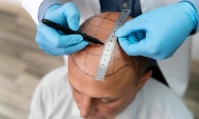 Quanto costa un trapianto di capelli