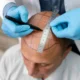 Quanto costa un trapianto di capelli