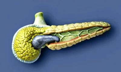 Spagna cura contro il tumore al pancreas