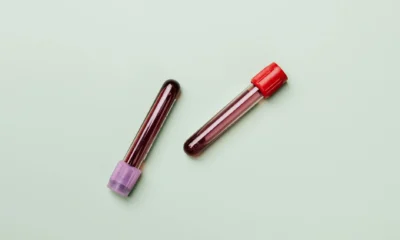 Resultados de análisis con tubo de sangre para explicar monociti alti analisi en un contexto médico