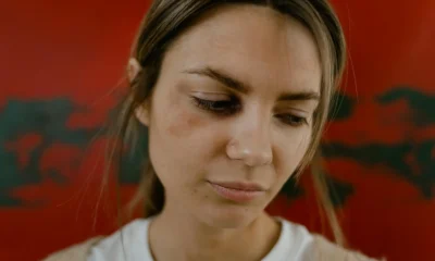 Primer plano de un rostro con un moretón para ilustrar come togliere un livido in poche ore.