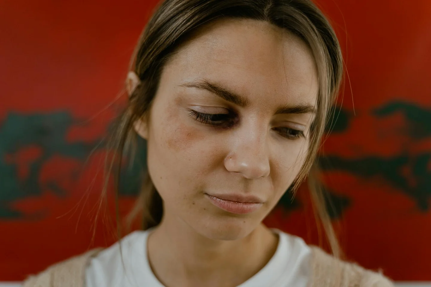 Primer plano de un rostro con un moretón para ilustrar come togliere un livido in poche ore.