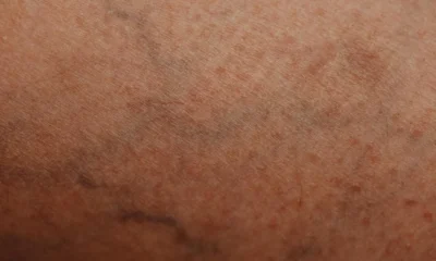 Ilustración de leg vein anatomy para explicar dove si trova la vena safena en el recorrido interno de la pierna.
