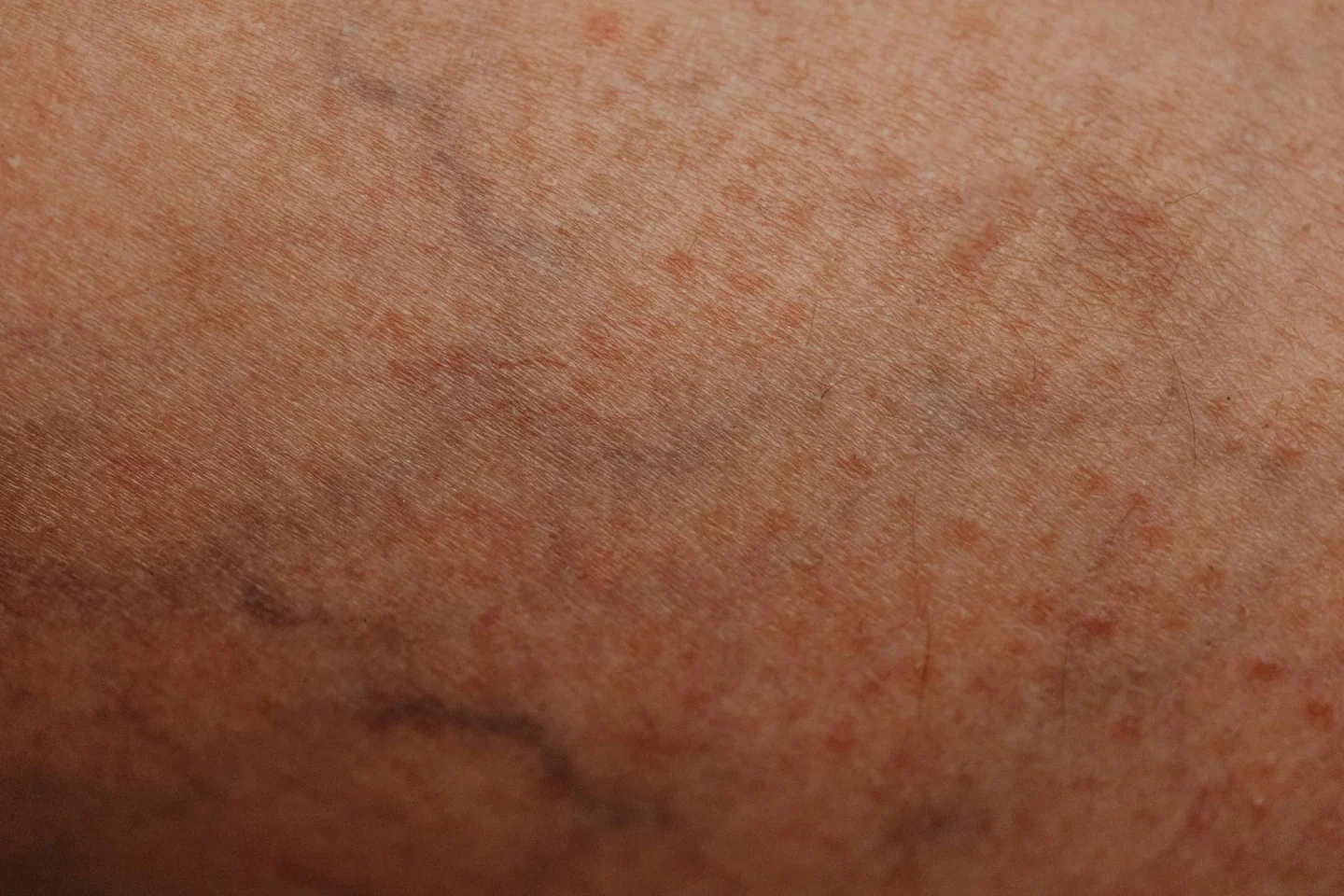 Ilustración de leg vein anatomy para explicar dove si trova la vena safena en el recorrido interno de la pierna.